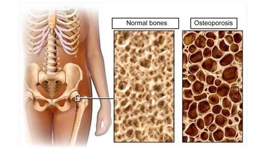 Moxibustion and Osteoporosis: Strengthening Bones Naturall
