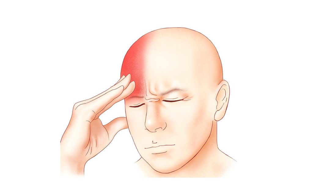 Can Moxibustion Help Manage Chronic Migraines?